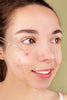 Treating Lightning Spots on the Face: How to Improve the Appearance of Acne Scars - Beauty You